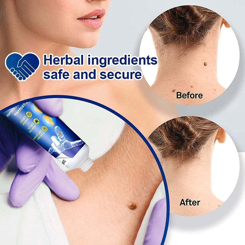 Wart Remover Ointment ( Pack Of 2 )